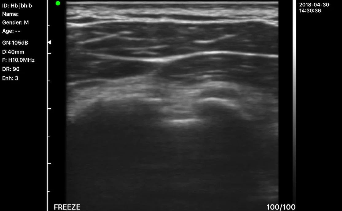 C10MX PRO B&W/Colour Superficial Linear Hand-Held Ultrasound