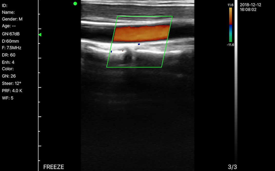 C10MX Pro Color Superfical Ultrasound Linear Probe