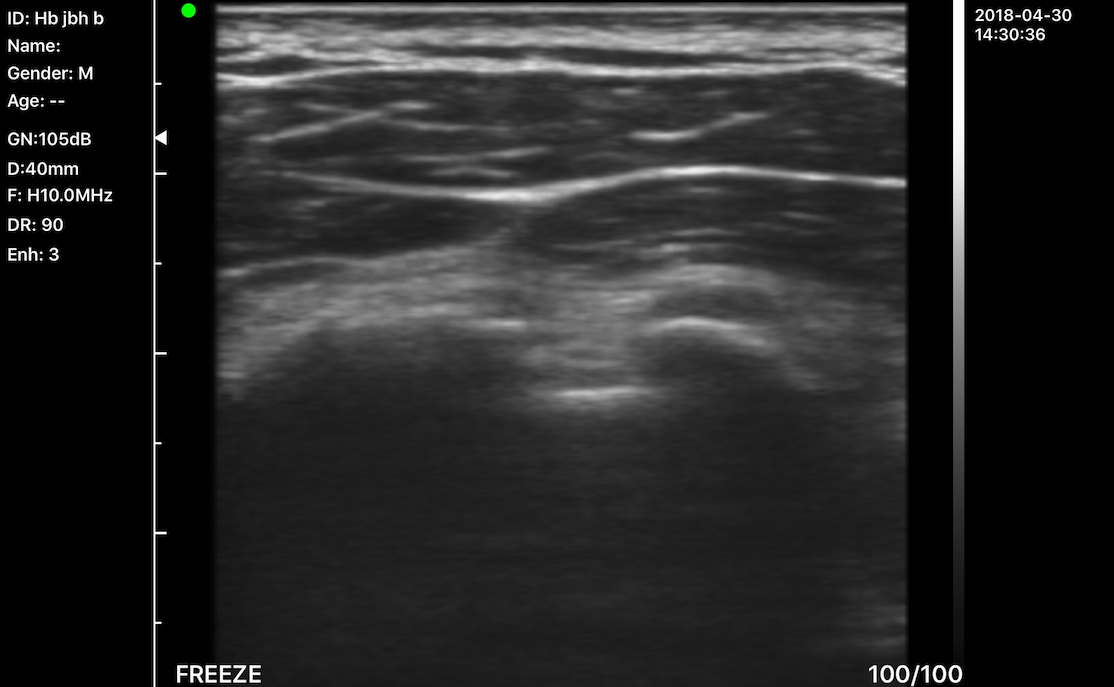 C10MX Pro Color Superfical Ultrasound Linear Probe