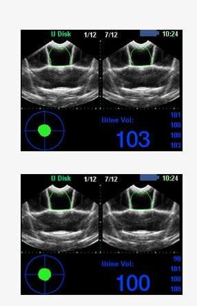 Kaixin BVT02 Bladder Scanner