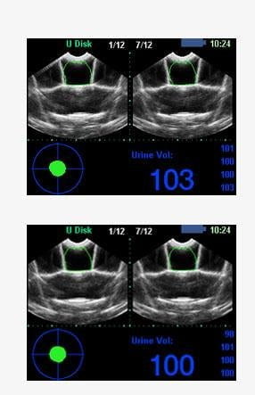 Kaixin BVT02 Bladder Scanner