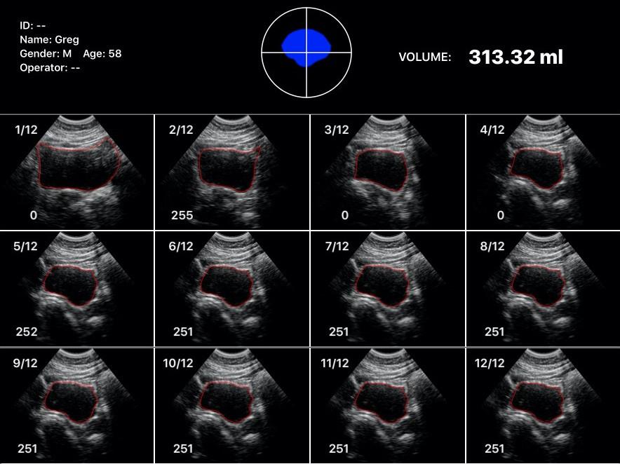 InterAktiv-Scan WiFi Bladder Scanner
